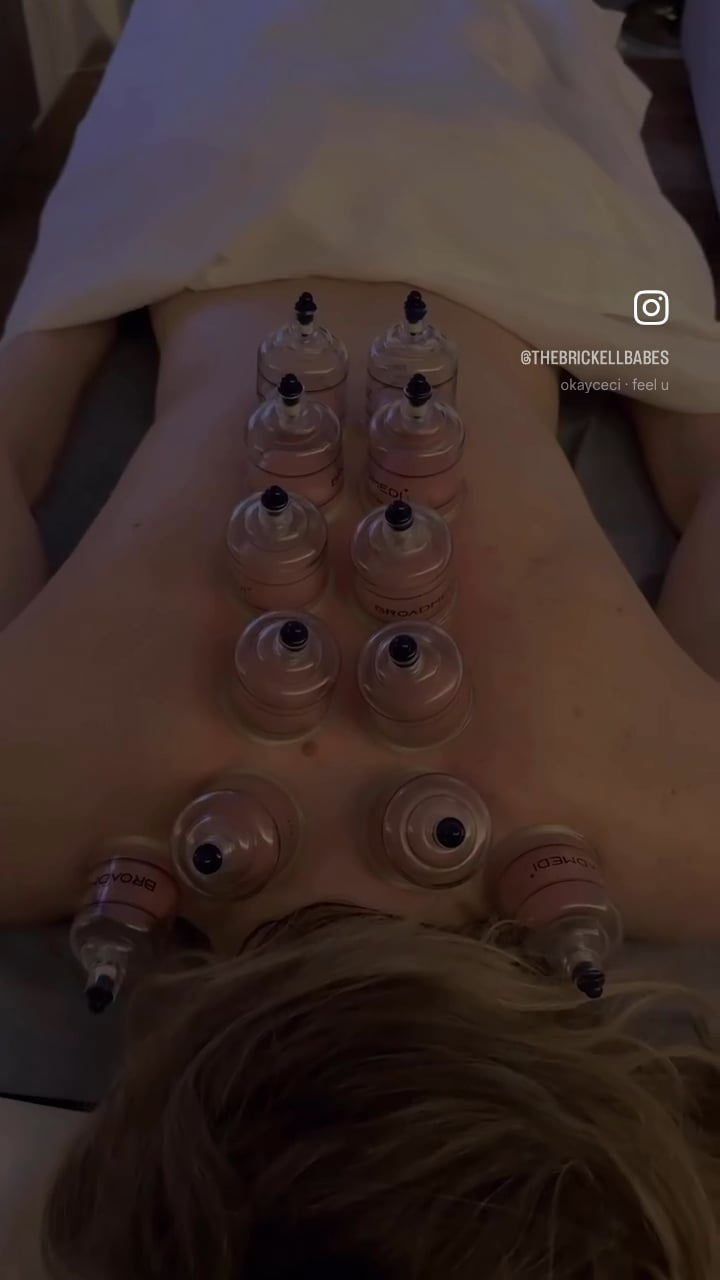 Cups placed along a client's back during a cupping session